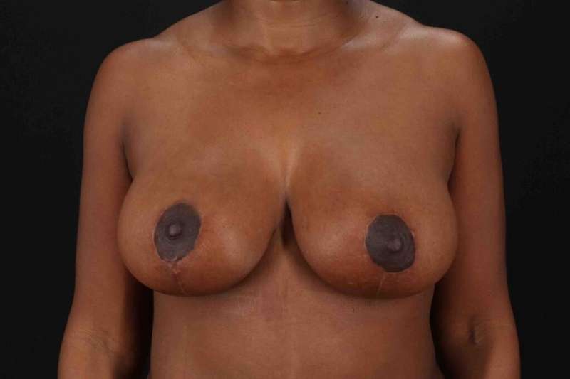 Breast Reduction With Lift Before & After Patient #3454