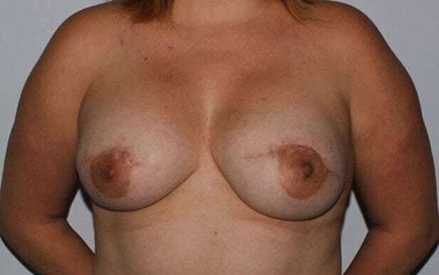 Nipple Areola Preservation (NAP) Before & After Patient #3457