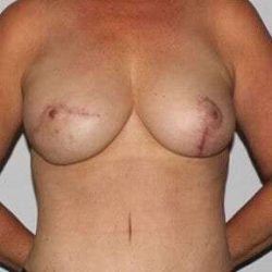 Nipple Areola Preservation (NAP) Before & After Patient #3460