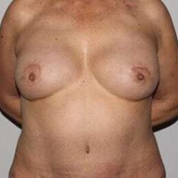Nipple Areola Preservation (NAP) Before & After Patient #3463