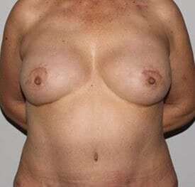 Nipple Areola Preservation (NAP) Before & After Patient #3463
