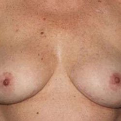 Nipple Areola Preservation (NAP) Before & After Patient #3466