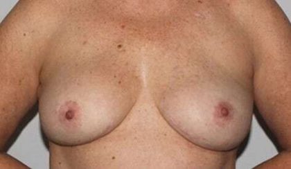 Nipple Areola Preservation (NAP) Before & After Patient #3466