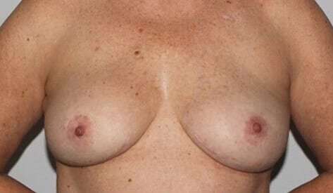 Nipple Areola Preservation (NAP) Before & After Patient #3466