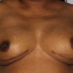 Nipple Areola Preservation (NAP) Before & After Patient #3469