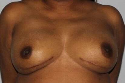 Nipple Areola Preservation (NAP) Before & After Patient #3469