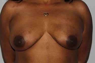 Nipple Areola Preservation (NAP) Before & After Patient #3472