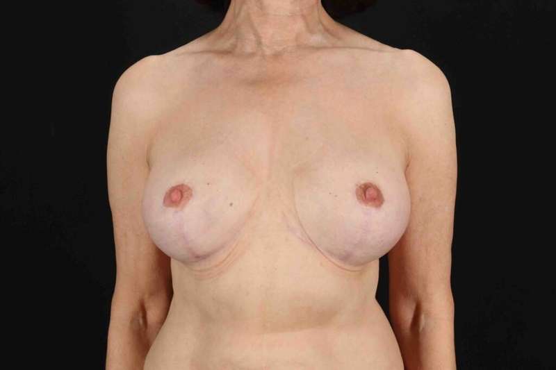 Breast Implant Removal Before & After Patient #3494