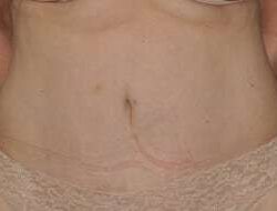 Abdominoplasty (Tummy Tuck) Before & After Patient #881