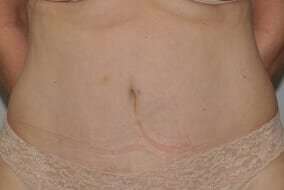 Abdominoplasty (Tummy Tuck) Before & After Patient #881
