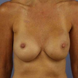 Implant Based Reconstruction Before & After Patient #3538