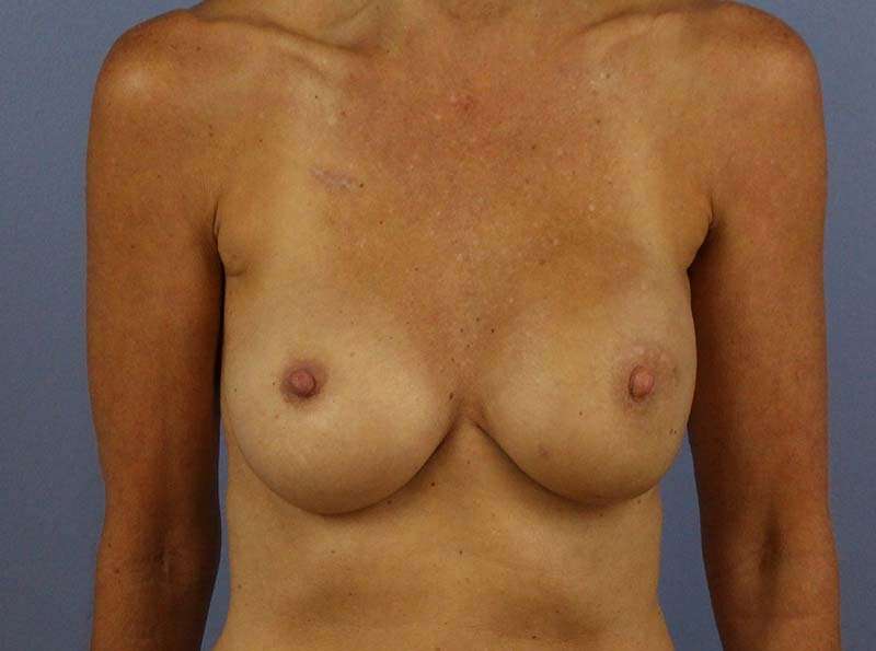 Implant Based Reconstruction Before & After Patient #3538