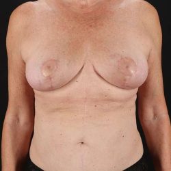 Breast Lift Before & After Patient #3582