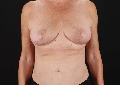 Breast Lift Before & After Patient #3582