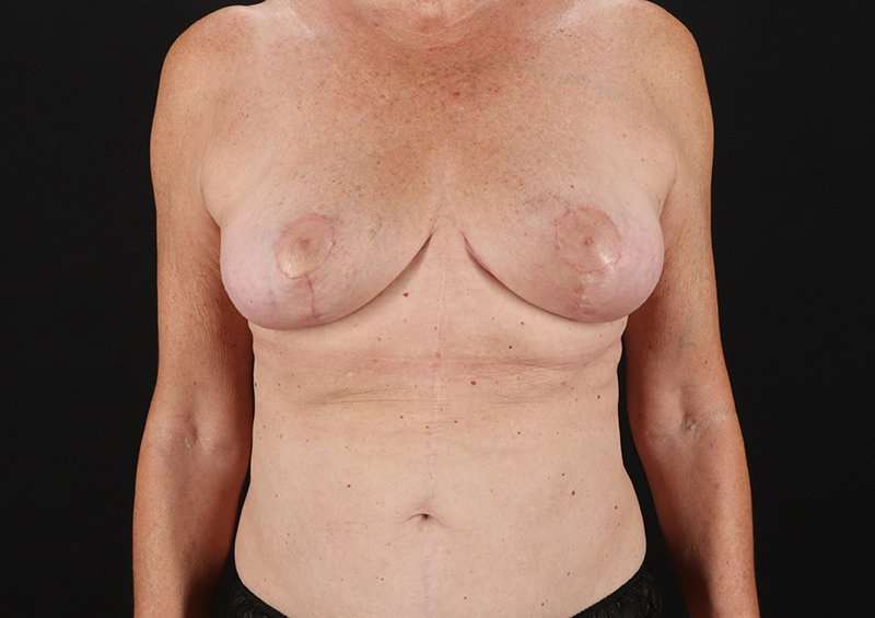Breast Lift Before & After Patient #3582
