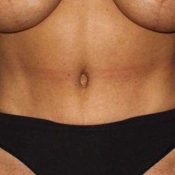 Abdominoplasty (Tummy Tuck) Before & After Patient #889