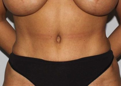 Abdominoplasty (Tummy Tuck) Before & After Patient #889