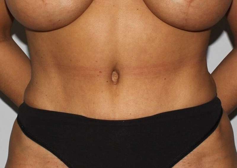 Abdominoplasty (Tummy Tuck) Before & After Patient #889