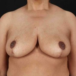 Breast Lift Before & After Patient #3626