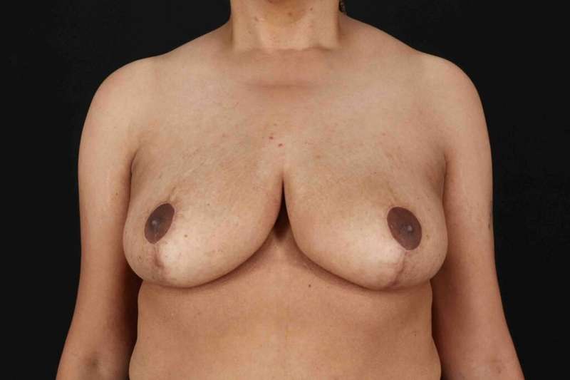 Breast Lift Before & After Patient #3626
