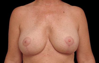 Breast Lift Before & After Patient #3633
