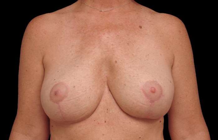 Breast Lift Before & After Patient #3633