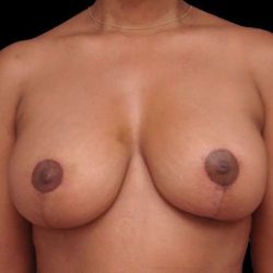 Breast Lift Before & After Patient #3640