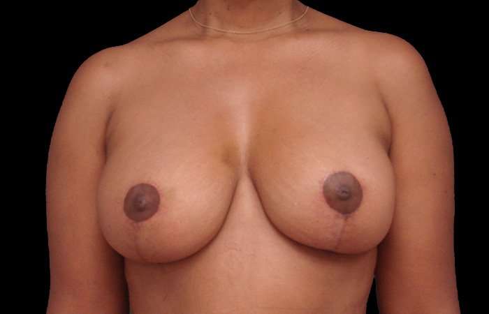 Breast Lift Before & After Patient #3640