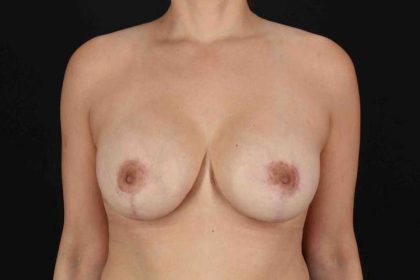 Breast Lift Before & After Patient #3651