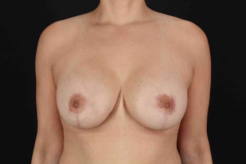 Breast Lift Before & After Patient #3651