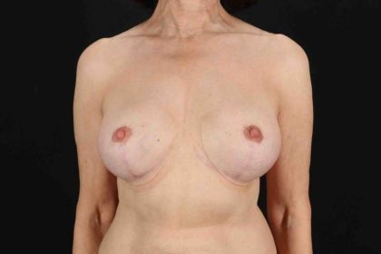 Breast Lift Before & After Patient #3662