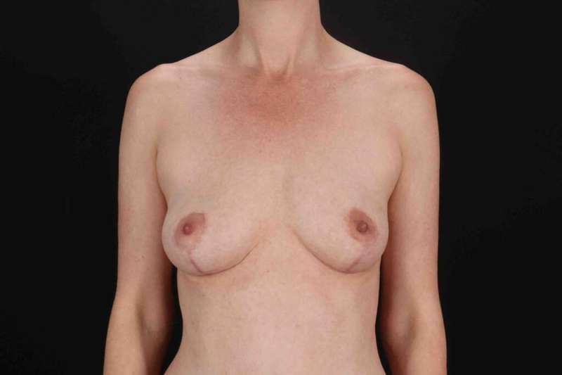 Breast Lift Before & After Patient #3673
