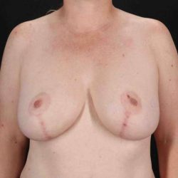 Breast Lift Before & After Patient #3684