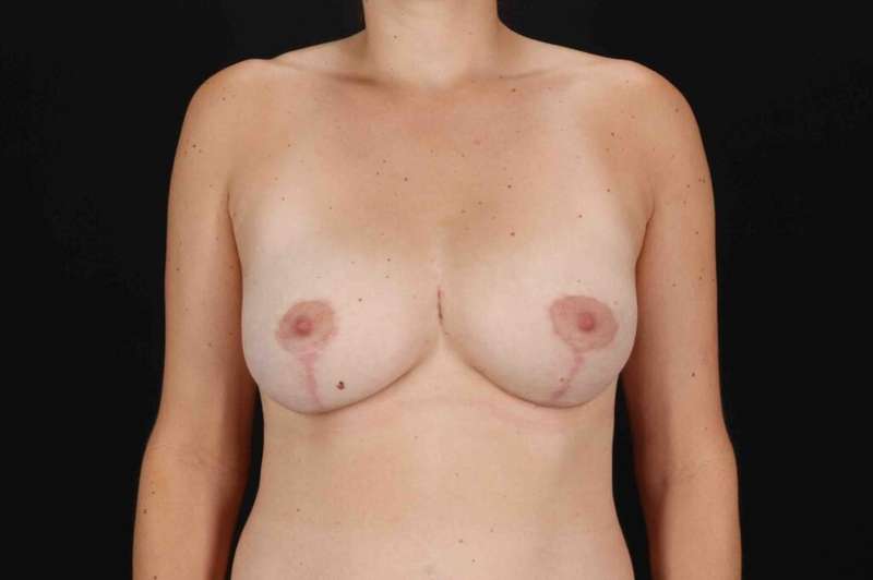 Breast Lift Before & After Patient #3695
