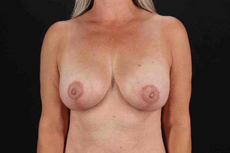 Breast Lift Before & After Patient #3706