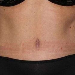 Abdominoplasty (Tummy Tuck) Before & After Patient #897