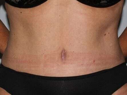 Abdominoplasty (Tummy Tuck) Before & After Patient #897
