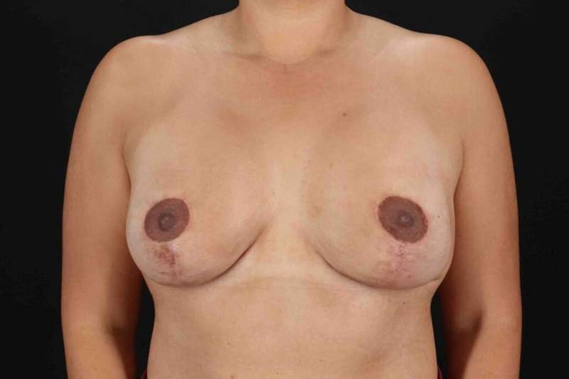 Breast Lift Before & After Patient #3717