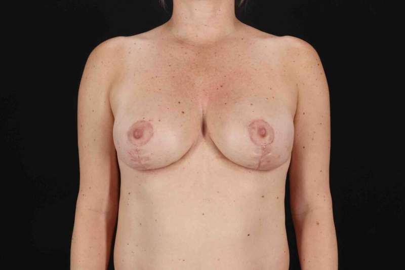 Breast Lift Before & After Patient #3728