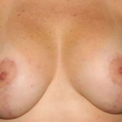 Breast Lift Before & After Patient #3779