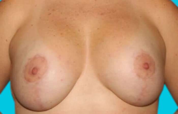 Breast Lift Before & After Patient #3779