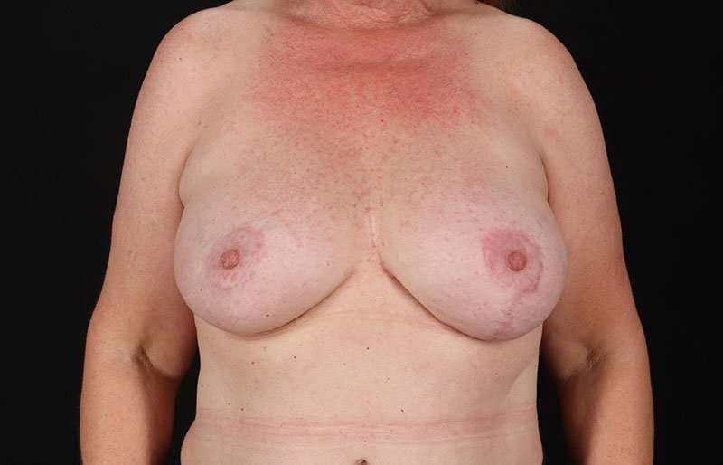 Breast Lift Before & After Patient #3809