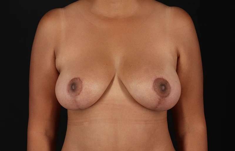 Breast Lift Before & After Patient #3840