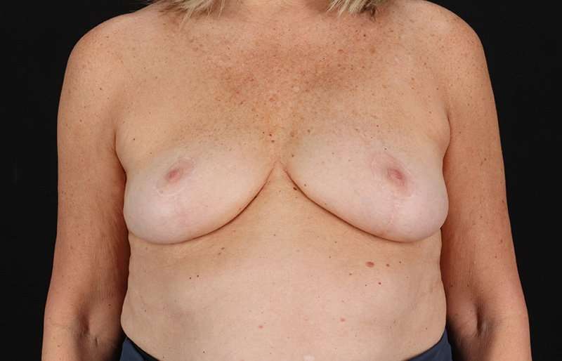 Breast Lift Before & After Patient #3864