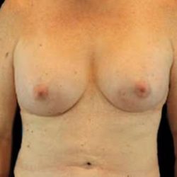 Male To Female Breast Before & After Patient #3893