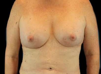 Male To Female Breast Before & After Patient #3893