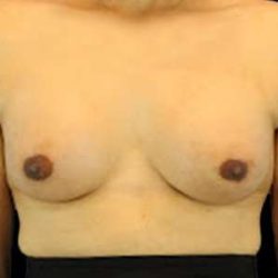 Male To Female Breast Before & After Patient #3900