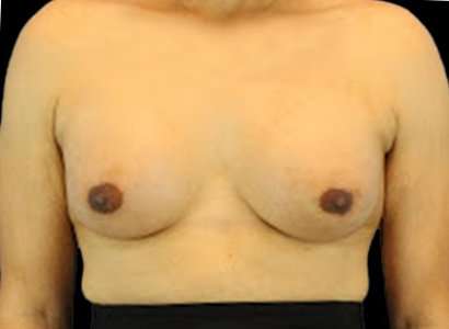 Male To Female Breast Before & After Patient #3900