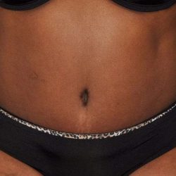 Abdominoplasty (Tummy Tuck) Before & After Patient #913