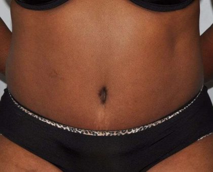 Abdominoplasty (Tummy Tuck) Before & After Patient #913